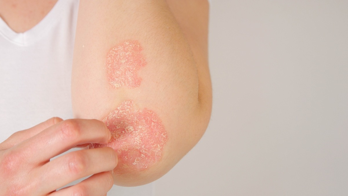 CLOSE UP: Unrecognizable young woman suffering from autoimmune incurable dermatological skin disease called psoriasis. Female gently scratching red, inflamed, scaly rash on elbows. Psoriatic arthritis