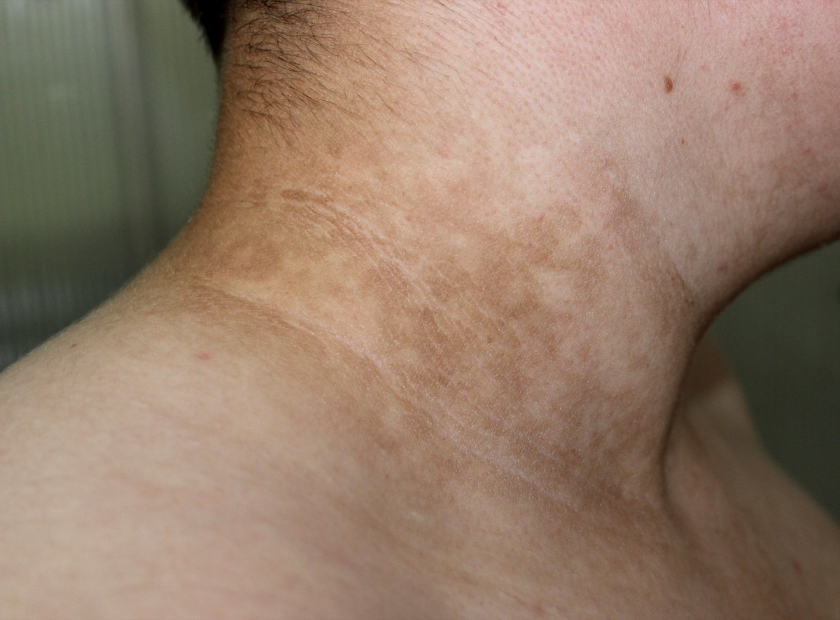 Acanthosis nigricans