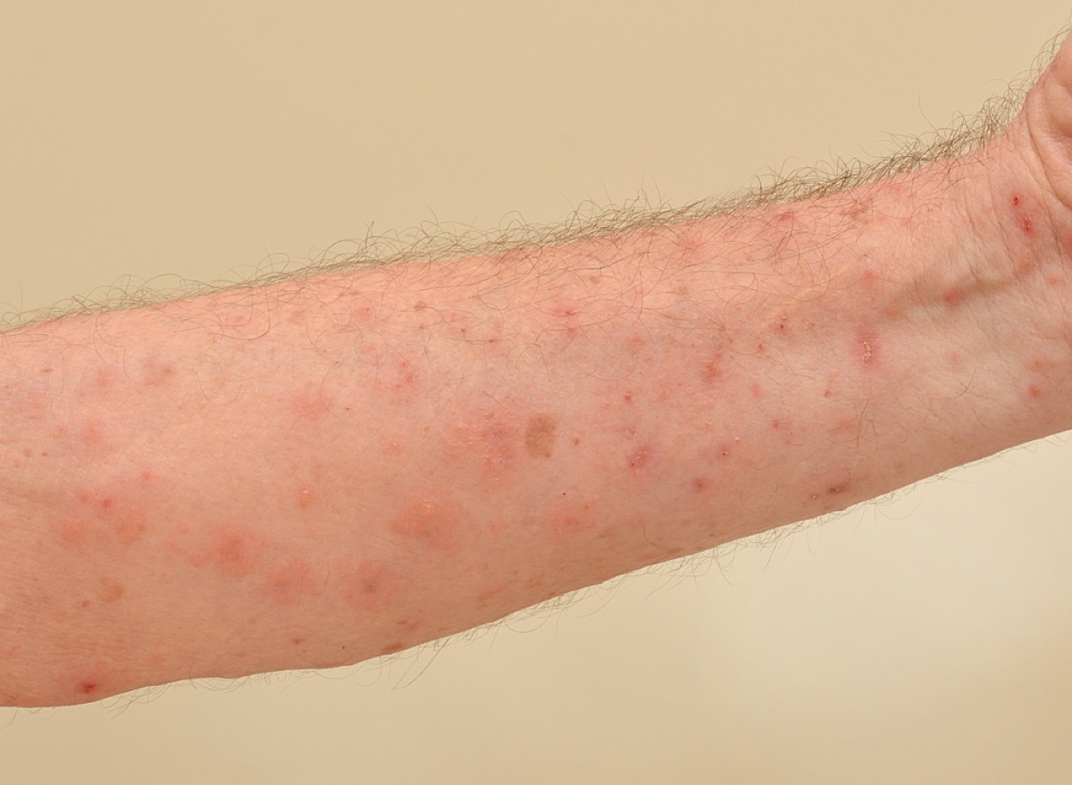 man with scabies bites on arm, contagious conditions