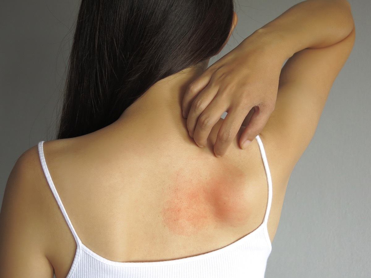 woman scratching her itchy back with allergy rash