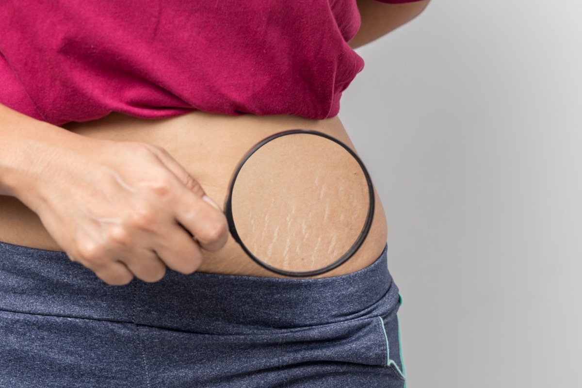 Woman shows stretch marks on her stomach.