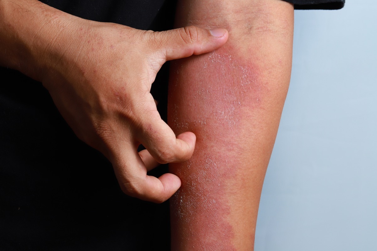 Man scratching his arm, medical atopic eczema allergy texture of ill human skin