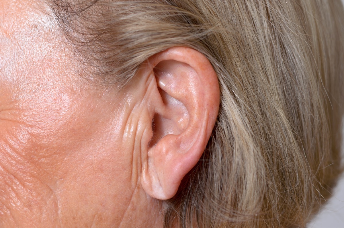 Earlobe crease