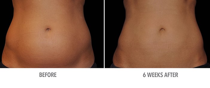 Results are not immediate | Coolsculpting Dos And Don'ts  | Her Beauty