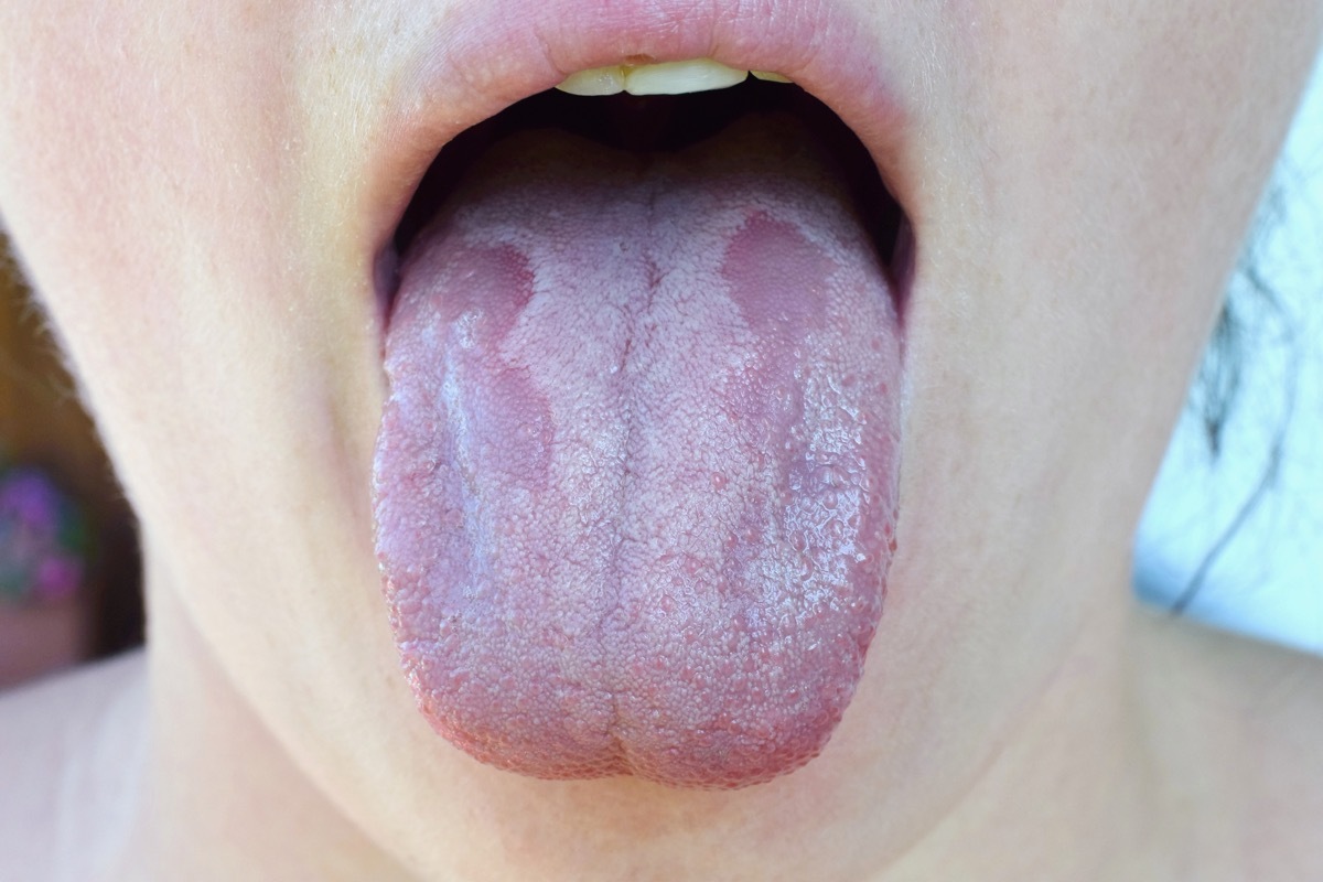 Thrush on woman's tongue