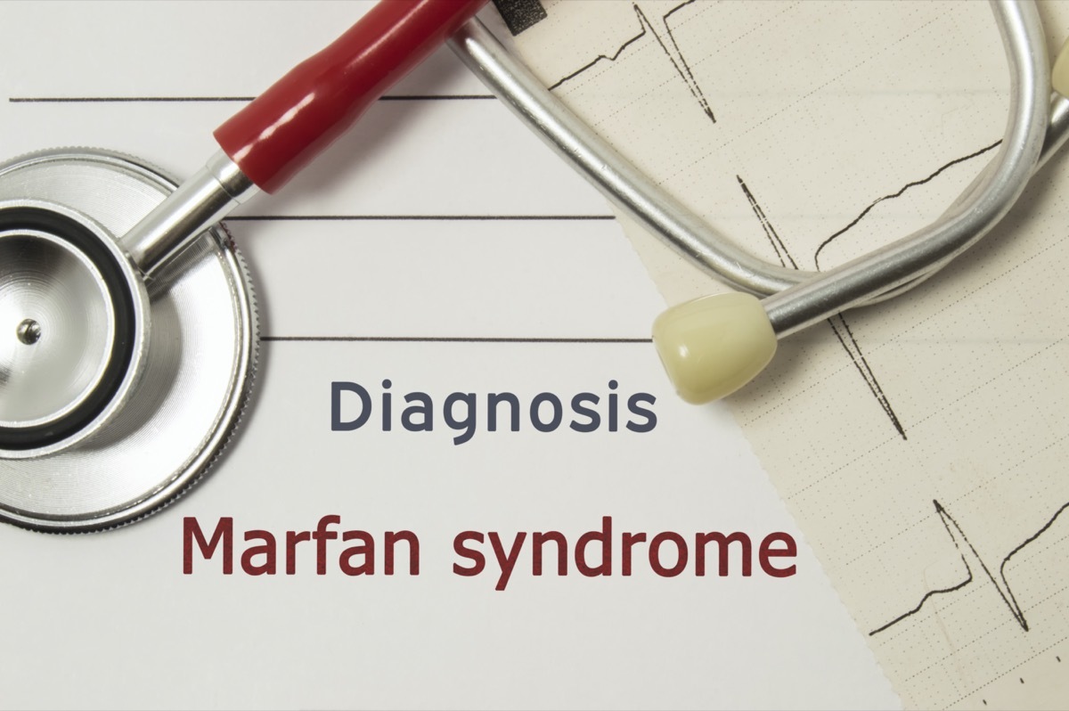 Cardiac diagnosis of Marfan Syndrome